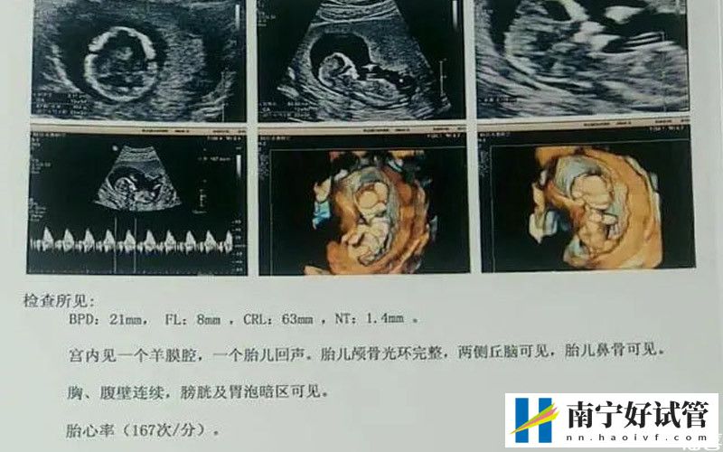 孕期nt检查正常参考值揭秘，准妈数值偏高不可掉以轻心(图2)