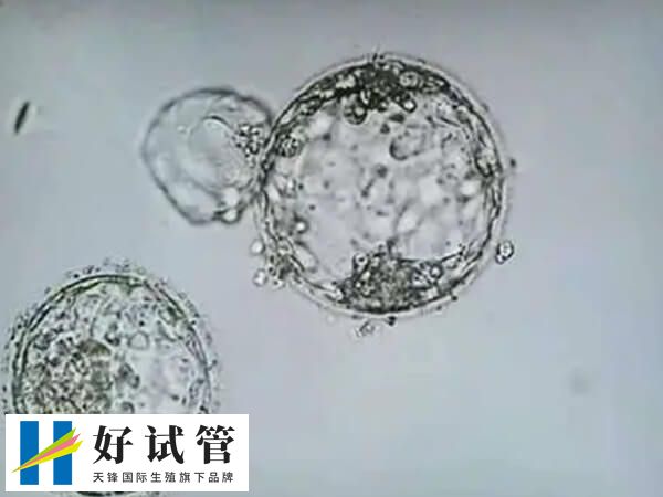 2pb是受精异常胚胎